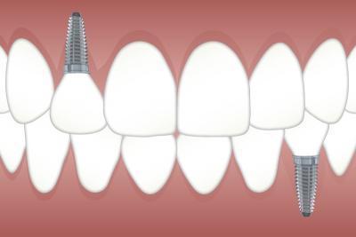nettoyage implant dentaire Bobigny